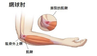 什么原因容易患網球肘