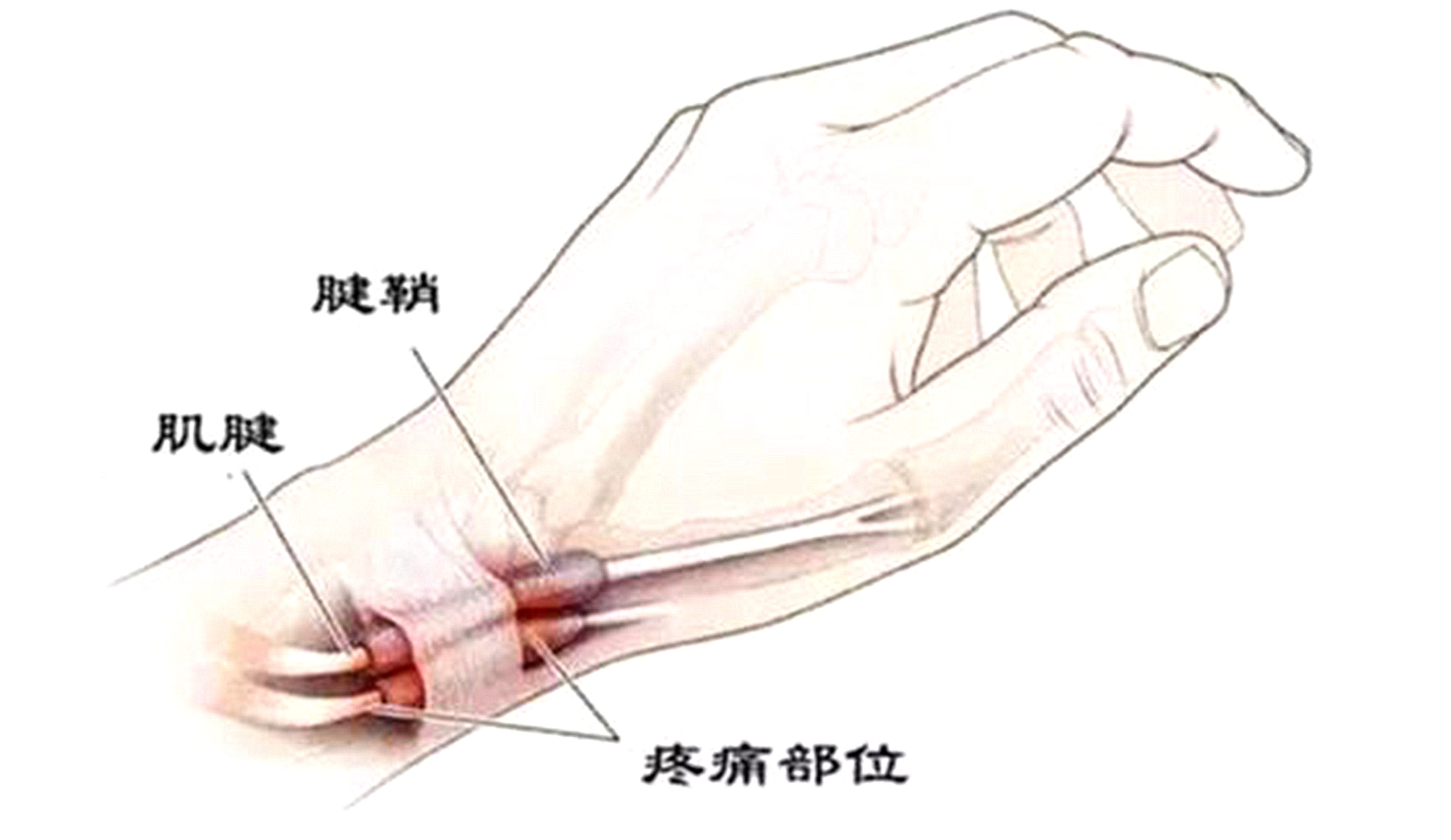 手腕酸痛的原因什么?怎么辦？