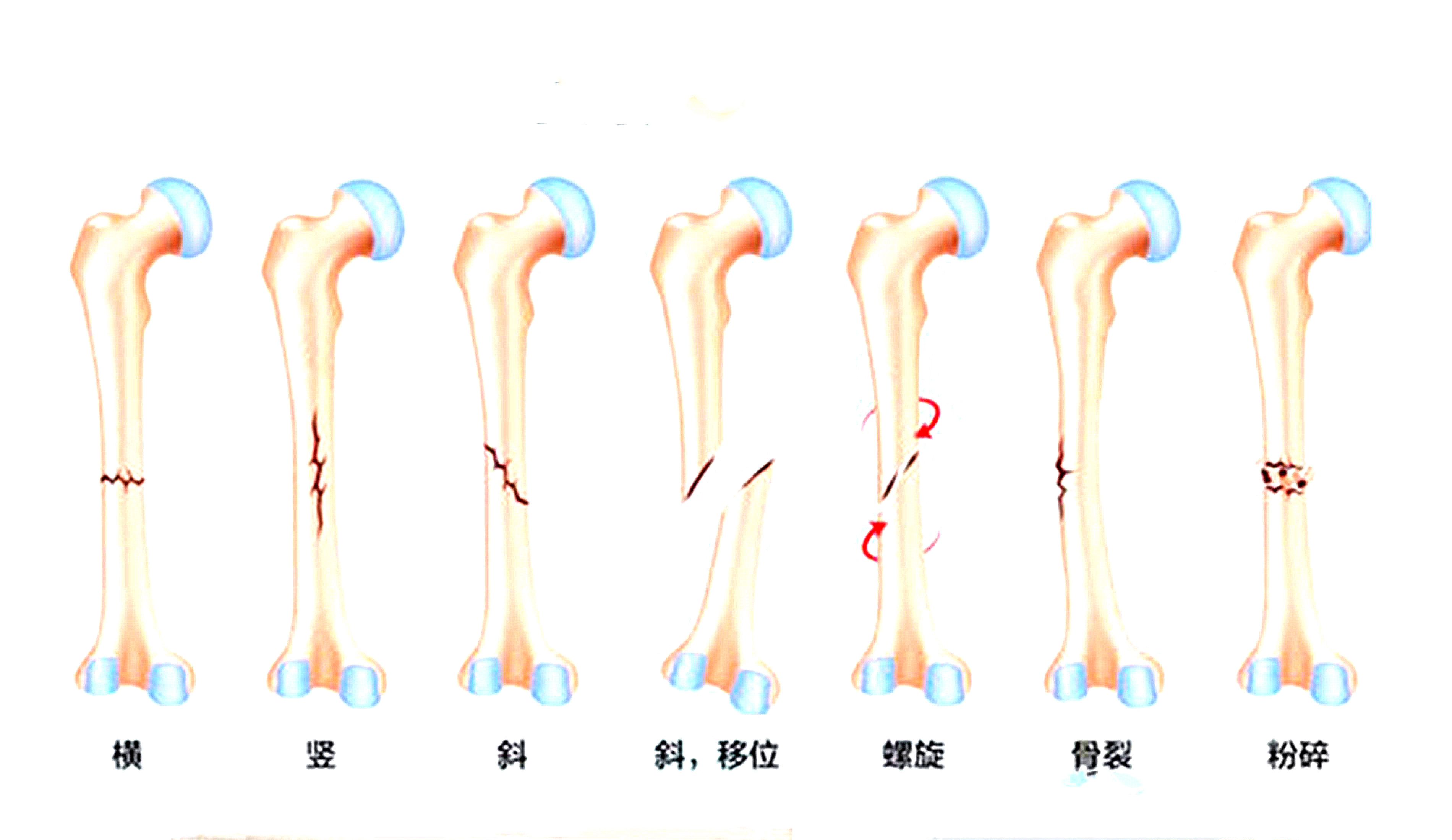 骨裂是骨折嗎？